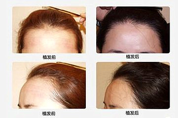 哪些人適合頭發加密手術